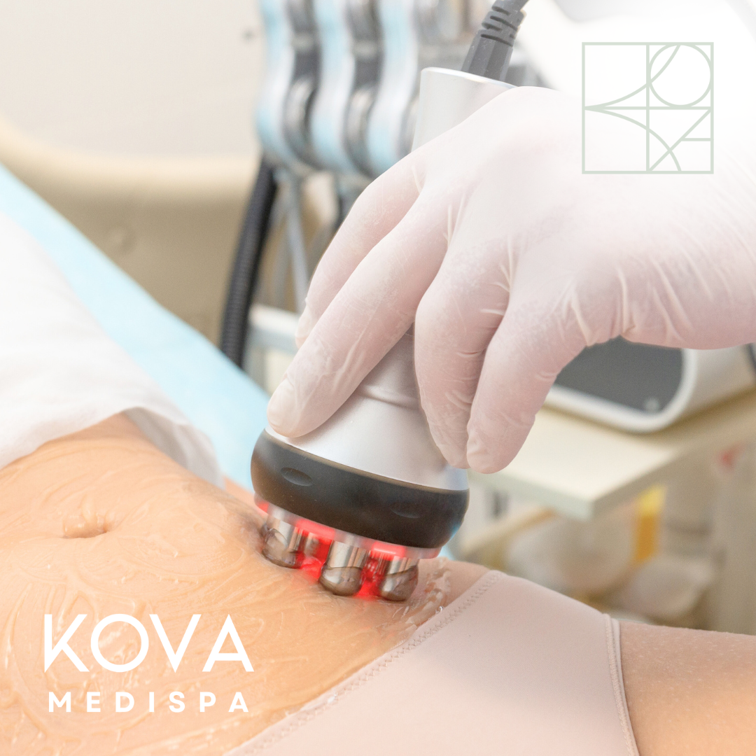 Radio Frequency (RF) Skin Tightening